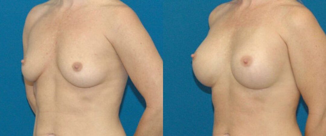 Breast Implant #8