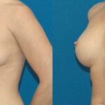 Breast Implant #8 - Before and After