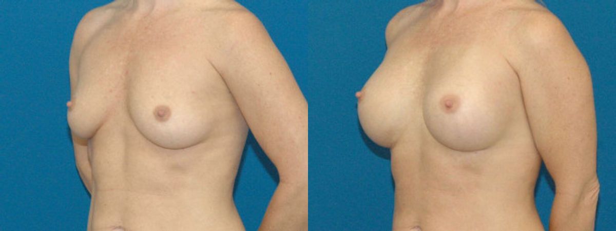 Breast Implant #8 - Before and After