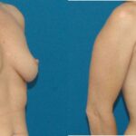 Breast Implant #8 - Before and After
