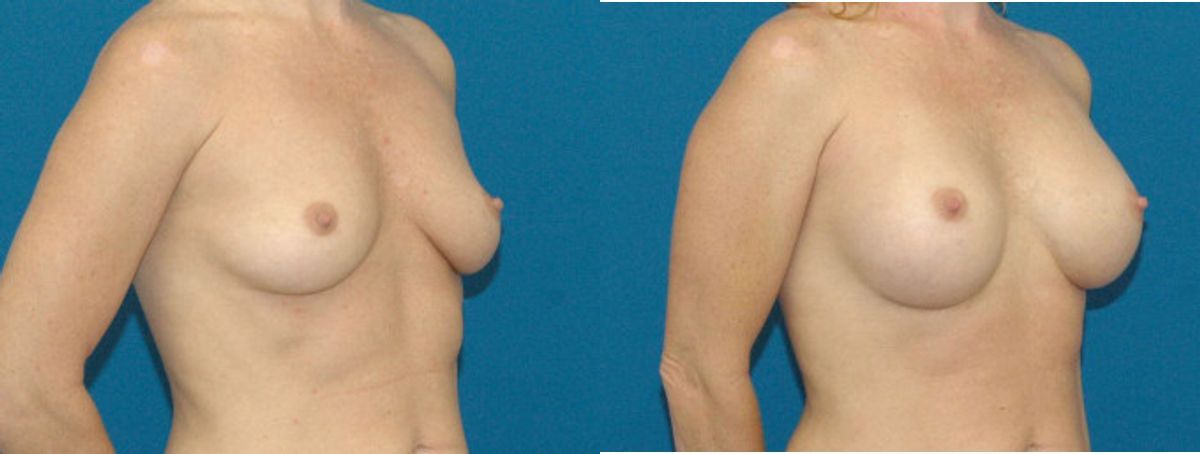 Breast Implant #8 - Before and After