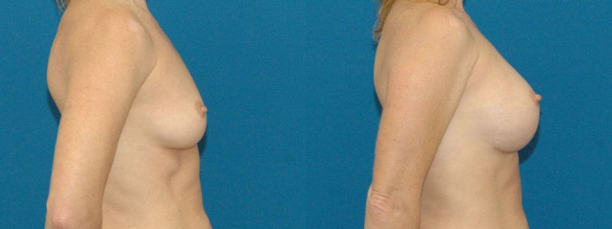 Breast Implant #8 - Before and After