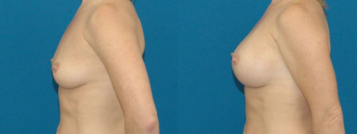 Breast Implant #8 - Before and After