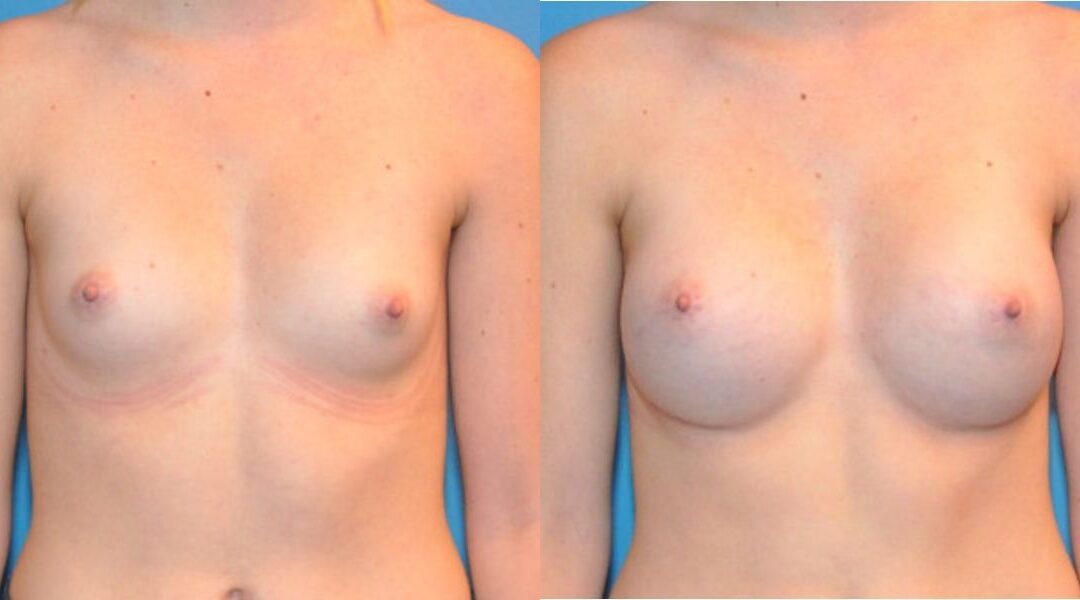 Breast Implant #9
