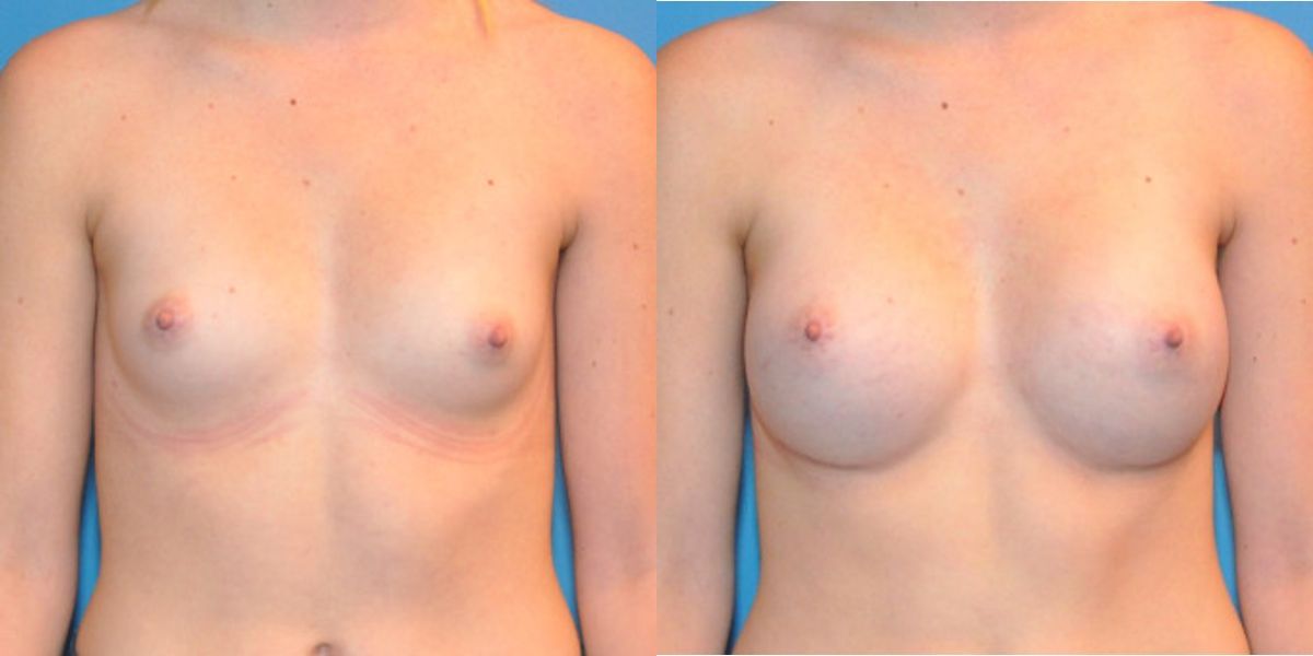 Breast Implant #9 - Before and After