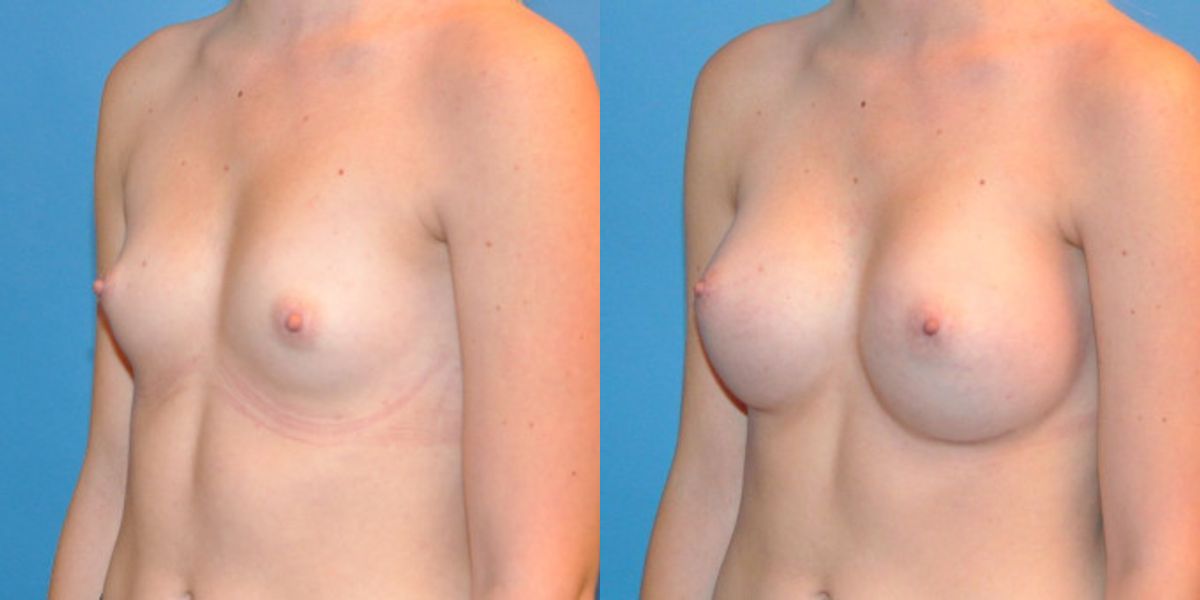 Breast Implant #9 - Before and After