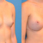 Breast Implant #9 - Before and After