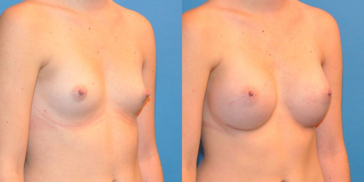 Breast Implant #9 - Before and After