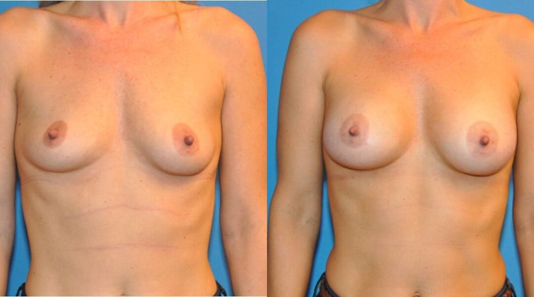 Breast Implant #10