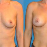 Breast Implant #10 - Before and After