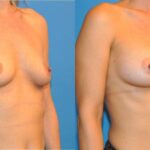 Breast Implant #10 - Before and After