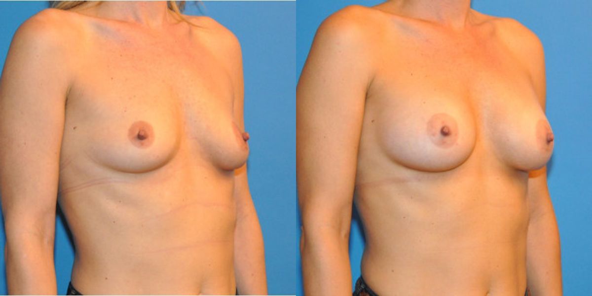 Breast Implant #10 - Before and After