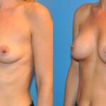 Breast Implant #10 - Before and After