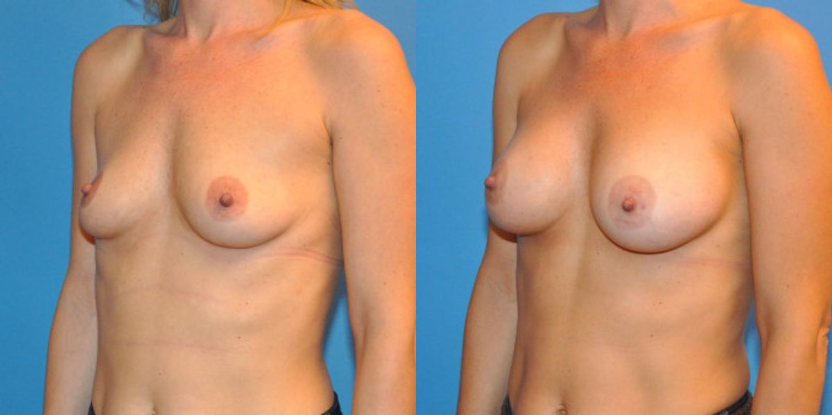 Breast Implant #10 - Before and After