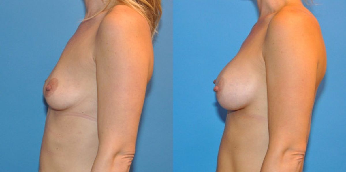 Breast Implant #10 - Before and After