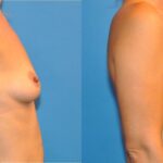Breast Implant #10 - Before and After