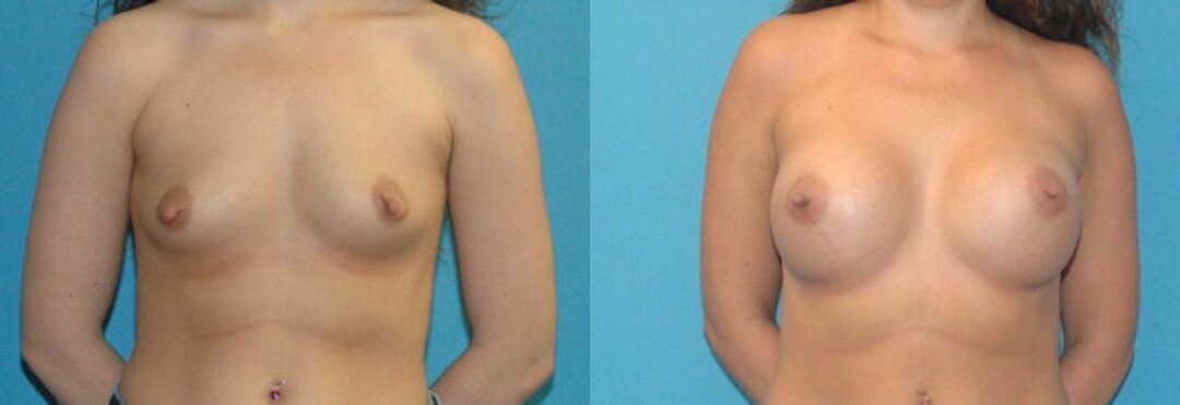 Breast Implant #100