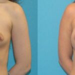 Breast Implant #100 - Before and After
