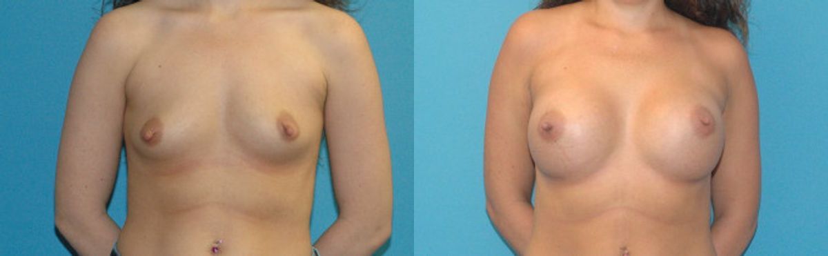 Breast Implant #100 - Before and After