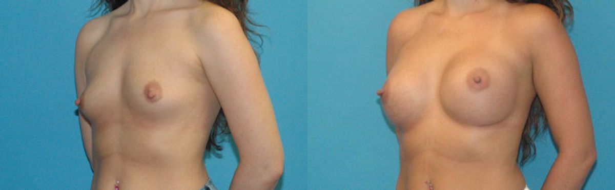 Breast Implant #100 - Before and After