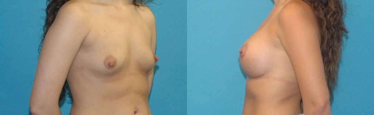 Breast Implant #100 - Before and After