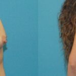Breast Implant #100 - Before and After