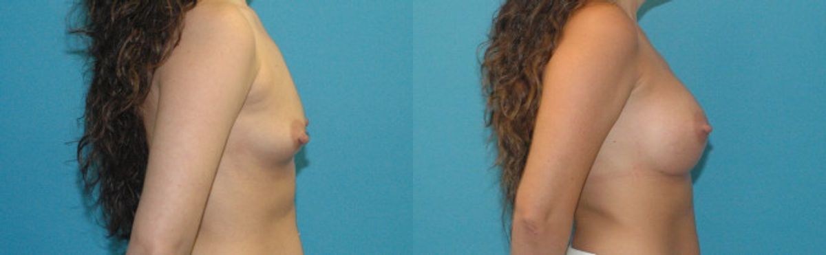 Breast Implant #100 - Before and After