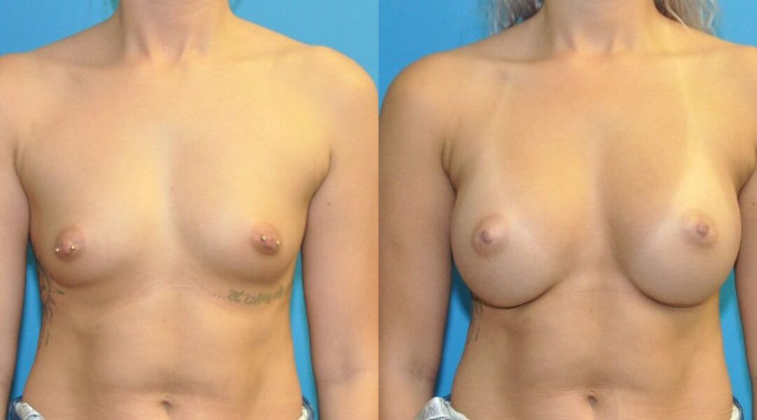 Breast Implant #101