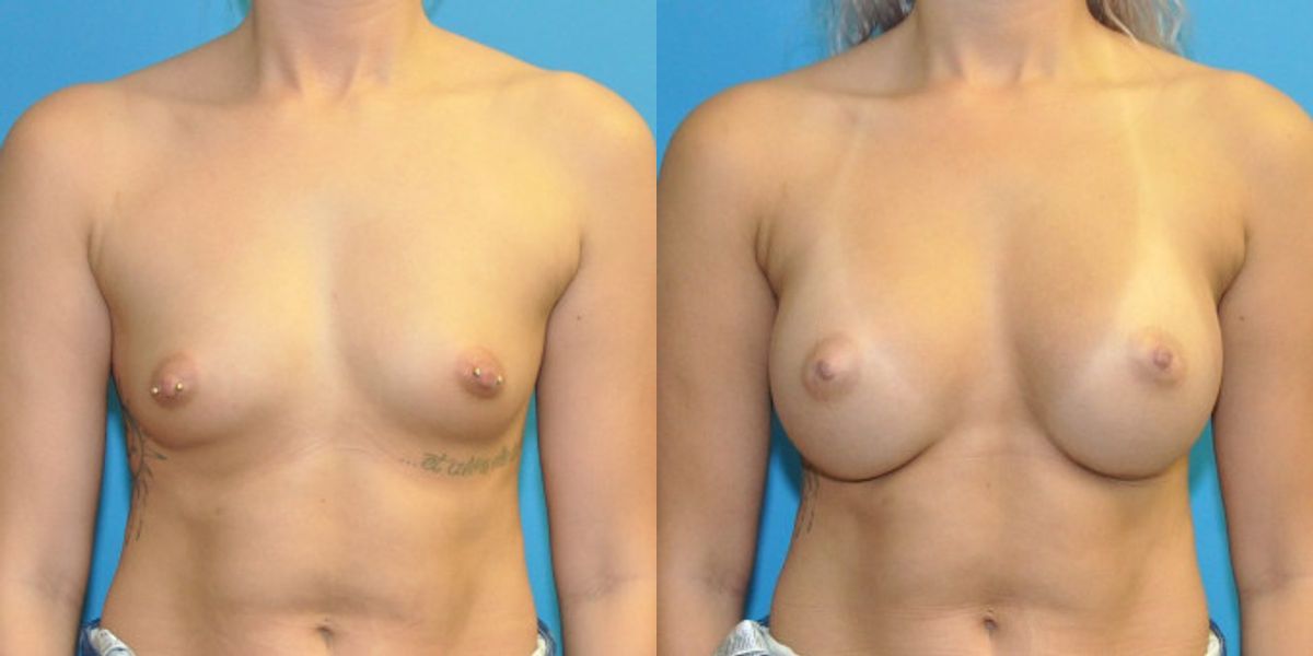 Breast Implant #101 - Before and After