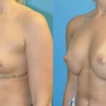 Breast Implant #101 - Before and After
