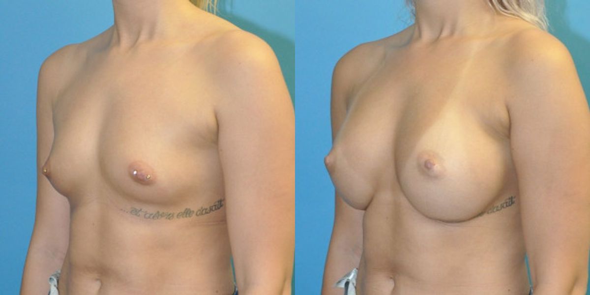 Breast Implant #101 - Before and After