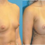 Breast Implant #101 - Before and After
