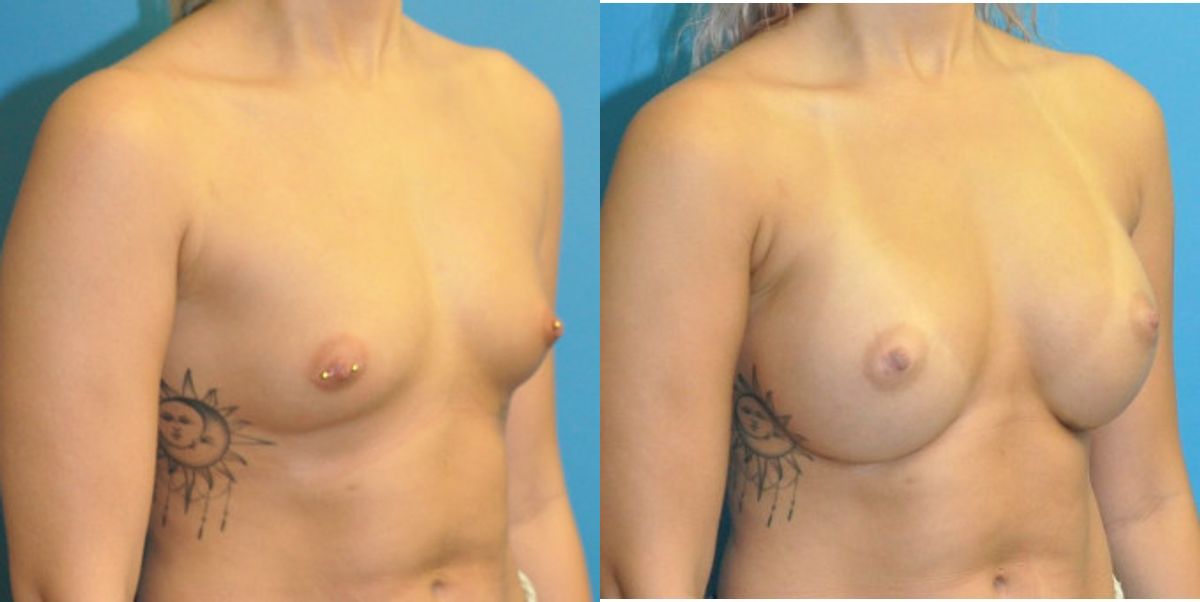 Breast Implant #101 - Before and After
