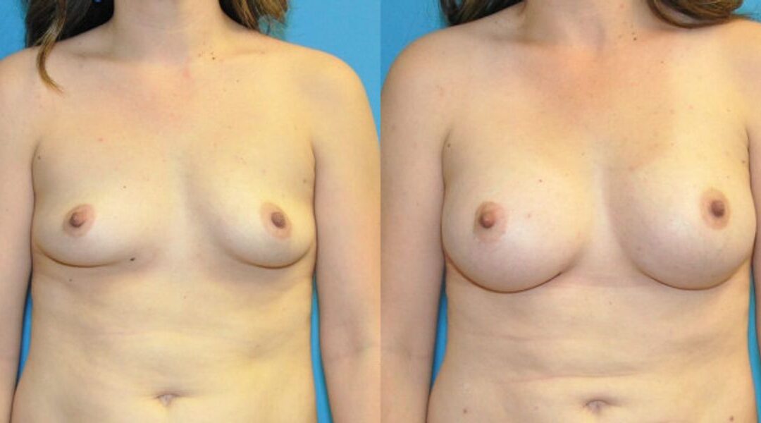 Breast Implant #102