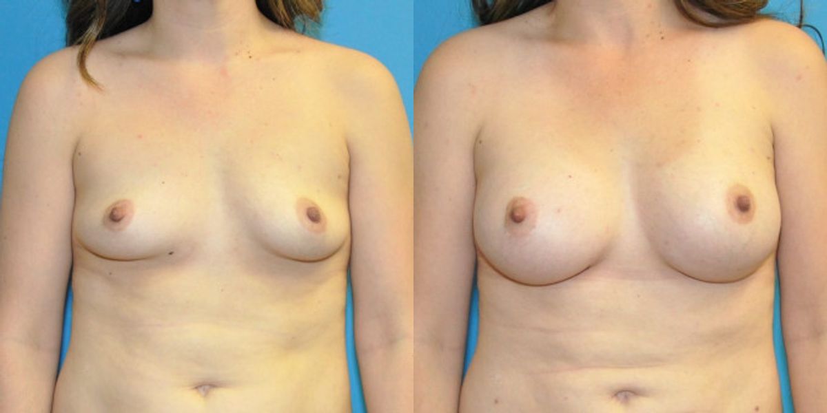 Breast Implant #102 - Before and After
