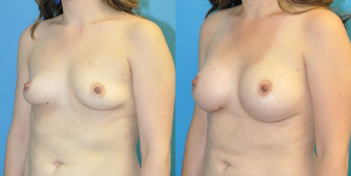 Breast Implant #102 - Before and After