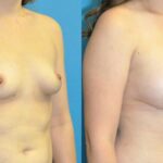 Breast Implant #102 - Before and After