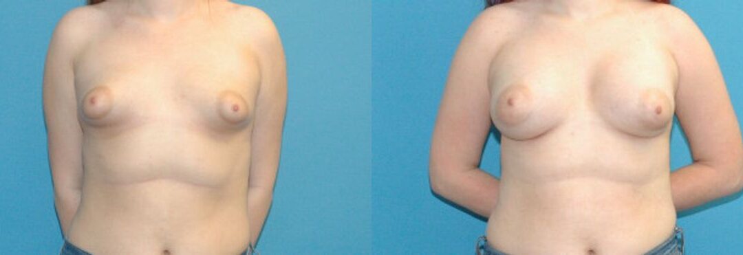 Breast Implant #103