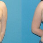 Breast Implant #103 - Before and After