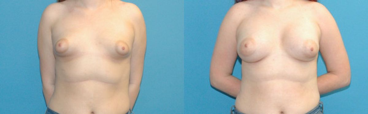 Breast Implant #103 - Before and After