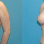 Breast Implant #103 - Before and After