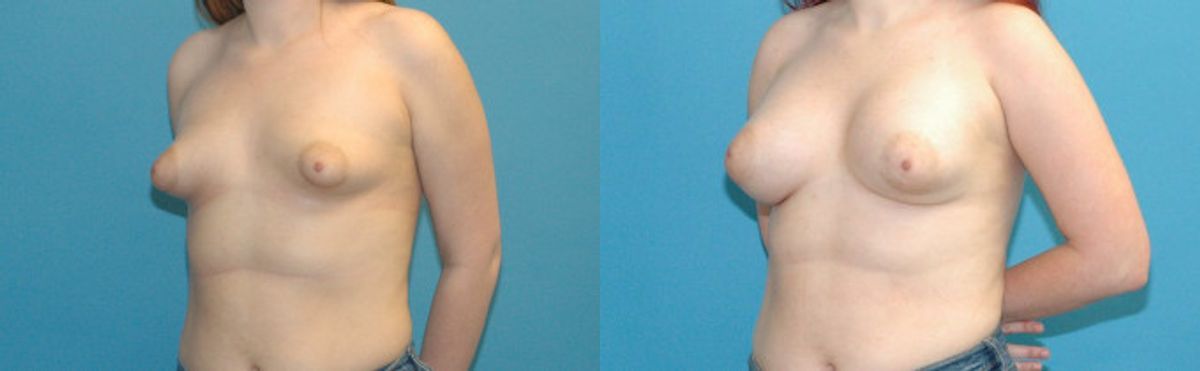Breast Implant #103 - Before and After