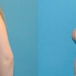 Breast Implant #103 - Before and After