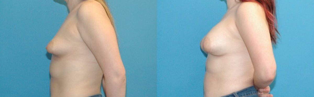 Breast Implant #103 - Before and After