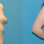 Breast Implant #103 - Before and After