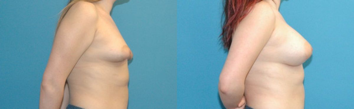 Breast Implant #103 - Before and After