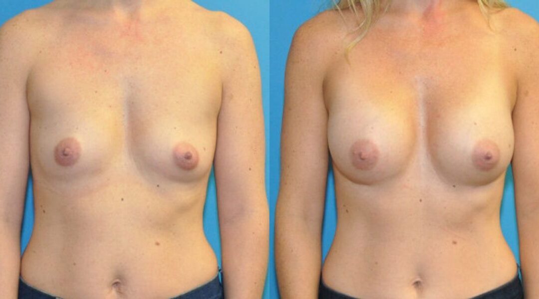 Breast Implant #104
