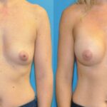 Breast Implant #104 - Before and After