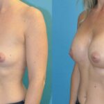 Breast Implant #104 - Before and After