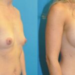 Breast Implant #104 - Before and After